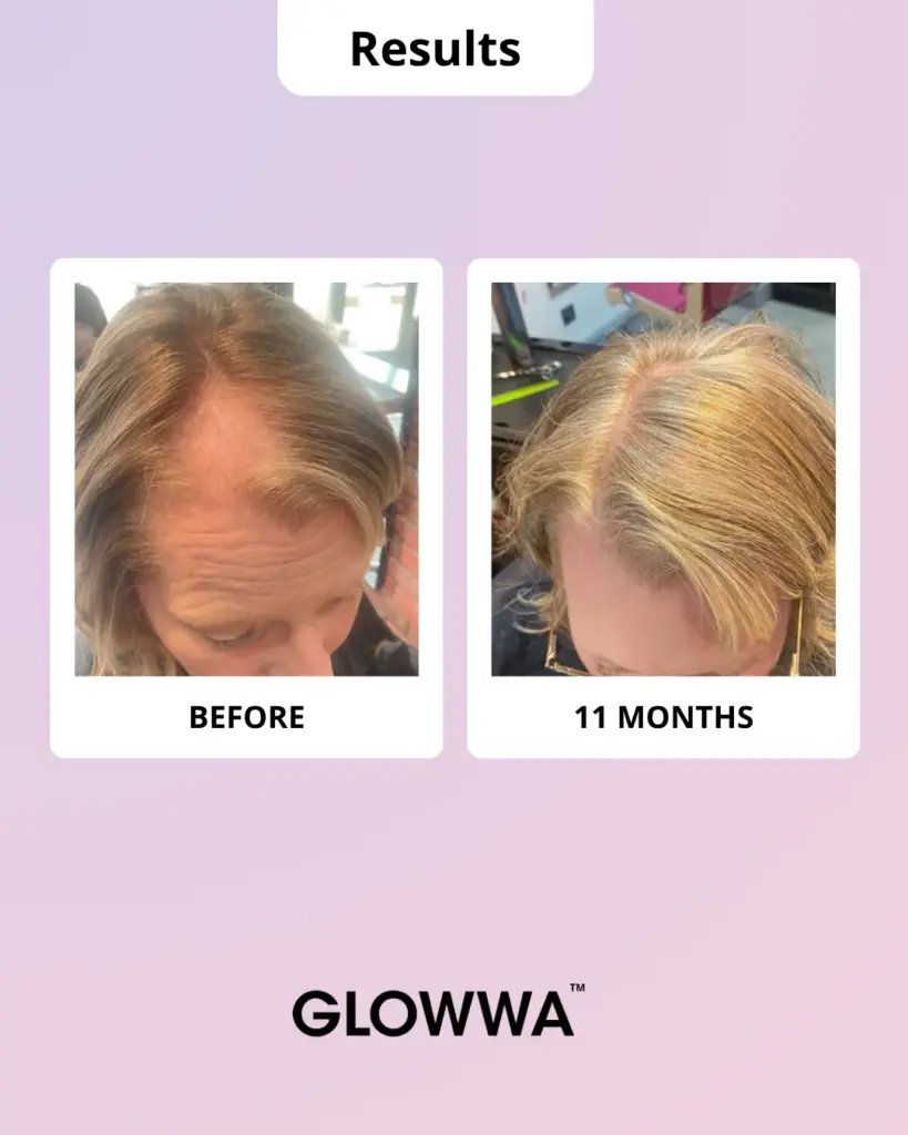Voor en na resultaat na 3 maanden Glowwa bij hormonale haaruitval tijdens de overgang
